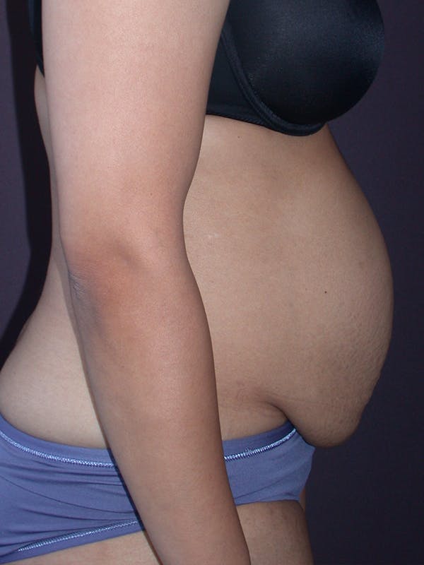 Tummy Tuck Gallery Before & After Gallery - Patient 7316694 - Image 3