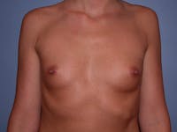 Breast Augmentation with Fat Before & After Gallery - Patient 7316696 - Image 1