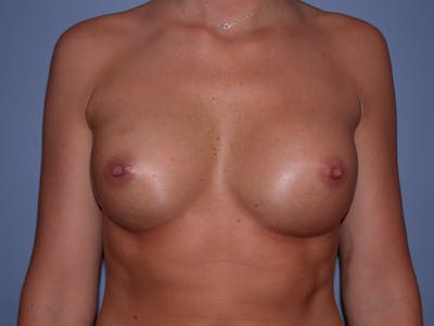 Breast Augmentation with Fat Gallery Before & After Gallery - Patient 7316696 - Image 2