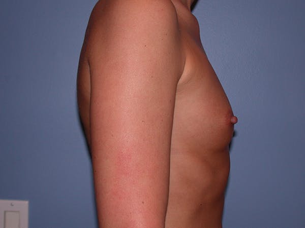 Breast Augmentation with Fat Gallery Before & After Gallery - Patient 7316696 - Image 5