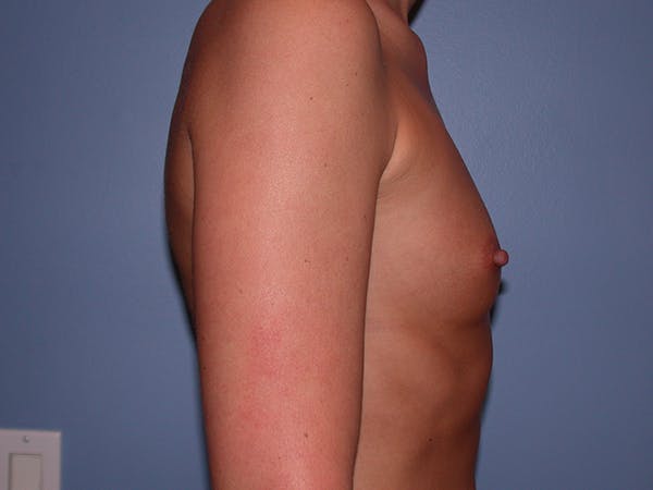 Breast Augmentation with Fat Before & After Gallery - Patient 7316696 - Image 5