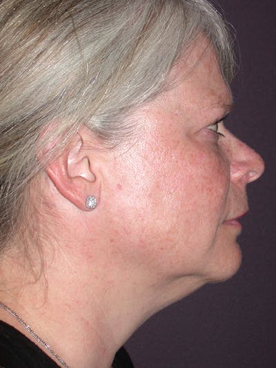 Neck Lift Gallery Before & After Gallery - Patient 12745336 - Image 1