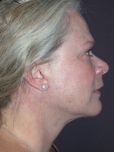 Neck Lift Gallery Before & After Gallery - Patient 12745336 - Image 2