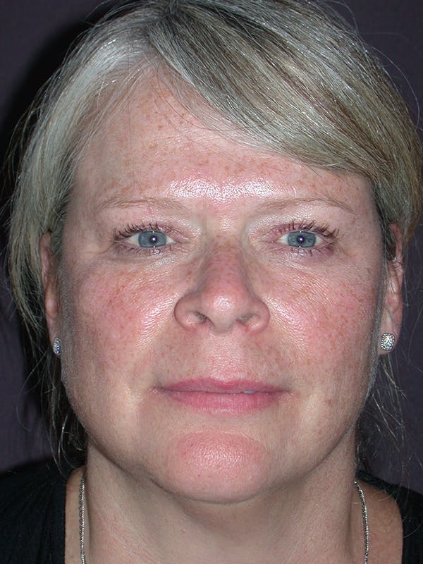 Neck Lift Gallery Before & After Gallery - Patient 12745336 - Image 3