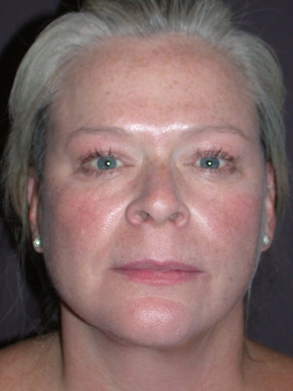 Neck Lift Before & After Gallery - Patient 12745336 - Image 4