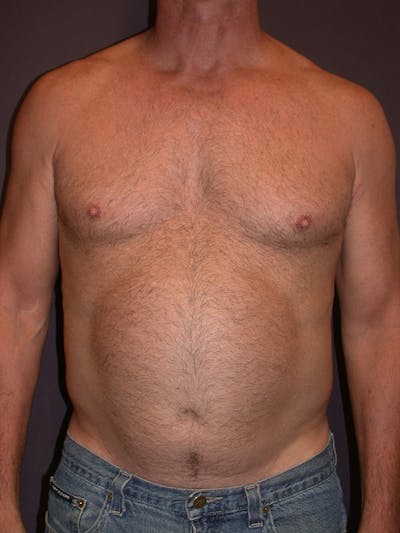 High Definition Liposuction Gallery Before & After Gallery - Patient 14779149 - Image 1