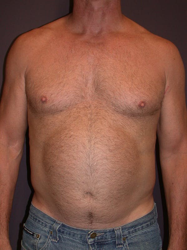 High Definition Liposuction Before & After Gallery - Patient 14779149 - Image 1