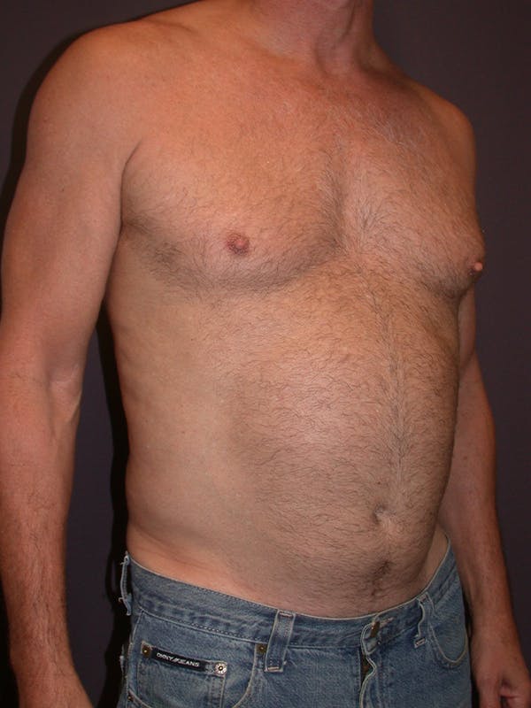 High Definition Liposuction Gallery Before & After Gallery - Patient 14779149 - Image 3