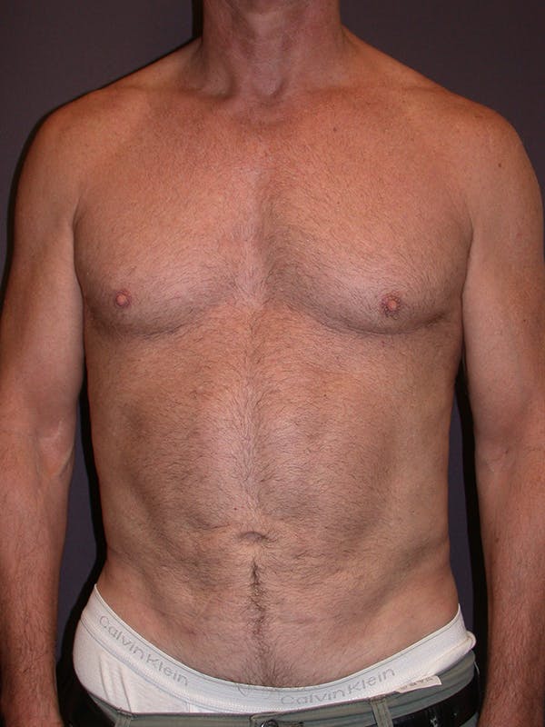Patient 2 Male Liposuction Before & After