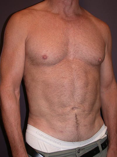 Liposuction Before & After Gallery - Patient 25852500 - Image 4