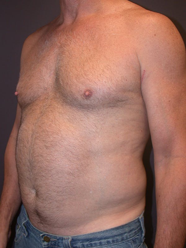 Liposuction Gallery Before & After Gallery - Patient 25852500 - Image 5