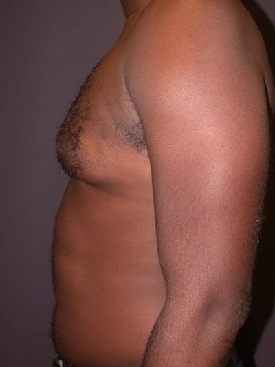 Male Liposuction Gallery Before & After Gallery - Patient 31198107 - Image 1