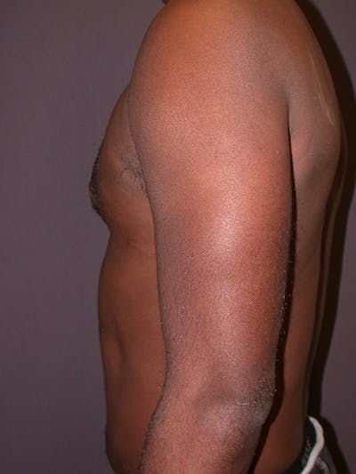 Male Liposuction Gallery Before & After Gallery - Patient 31198107 - Image 2