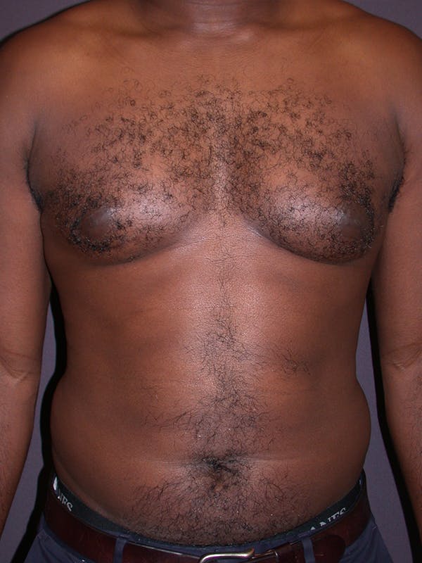 Male Liposuction Gallery Before & After Gallery - Patient 31198107 - Image 3