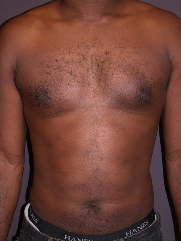 Male Liposuction Gallery Before & After Gallery - Patient 31198107 - Image 4