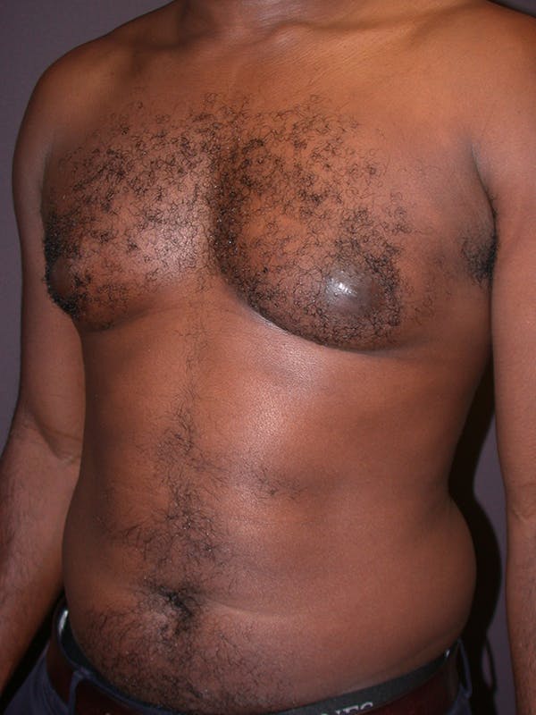 Male Liposuction Gallery Before & After Gallery - Patient 31198107 - Image 5