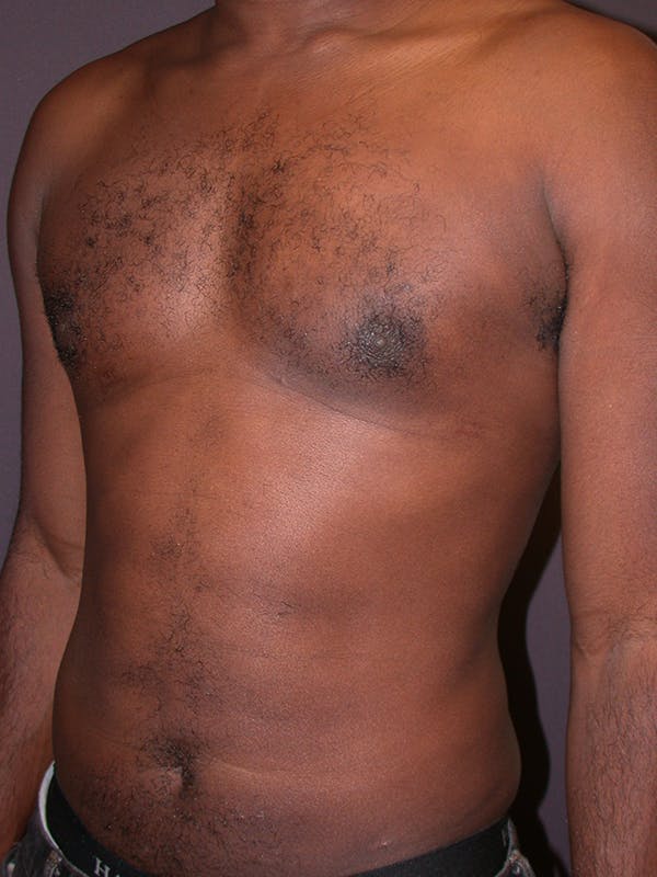 Male Liposuction Gallery Before & After Gallery - Patient 31198107 - Image 6