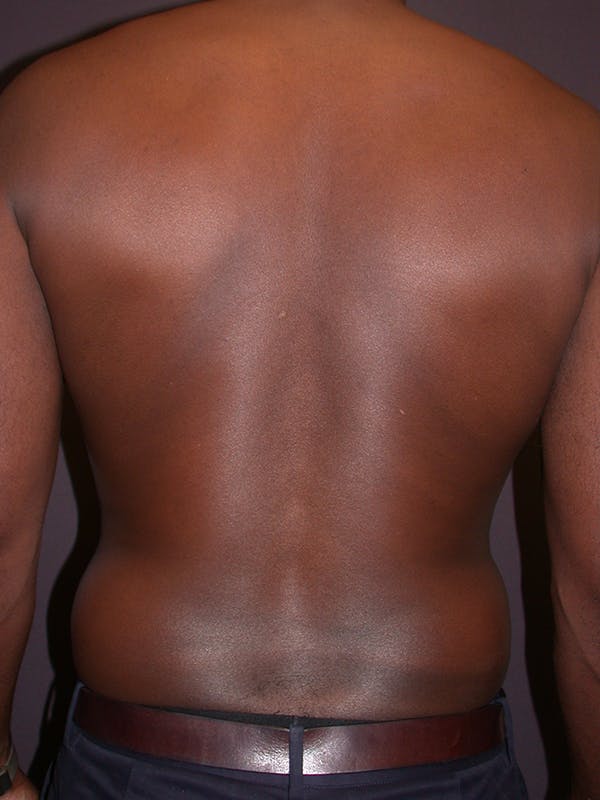 Male Liposuction Gallery Before & After Gallery - Patient 31198107 - Image 7
