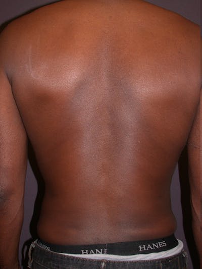 Male Liposuction Gallery Before & After Gallery - Patient 31198107 - Image 8