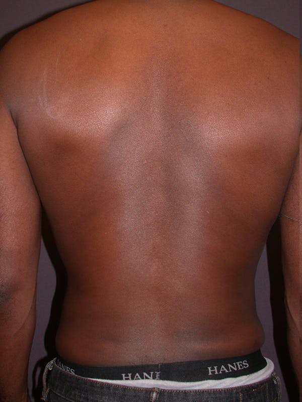 Male Liposuction Gallery Before & After Gallery - Patient 31198107 - Image 8