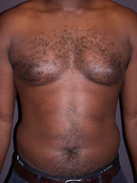 Liposuction Gallery Before & After Gallery - Patient 31198116 - Image 1