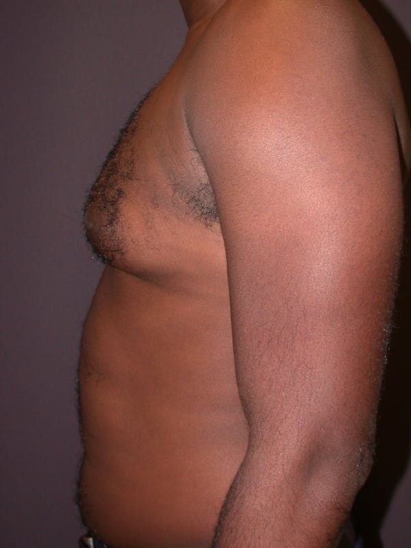 Liposuction Gallery Before & After Gallery - Patient 31198116 - Image 3