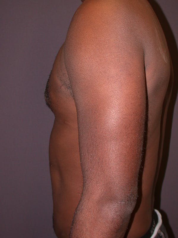 Liposuction Gallery - Patient 31198116 - Image 4