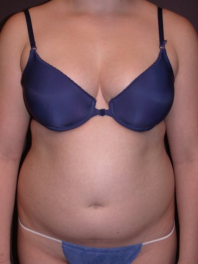 Liposuction Gallery Before & After Gallery - Patient 31382055 - Image 1