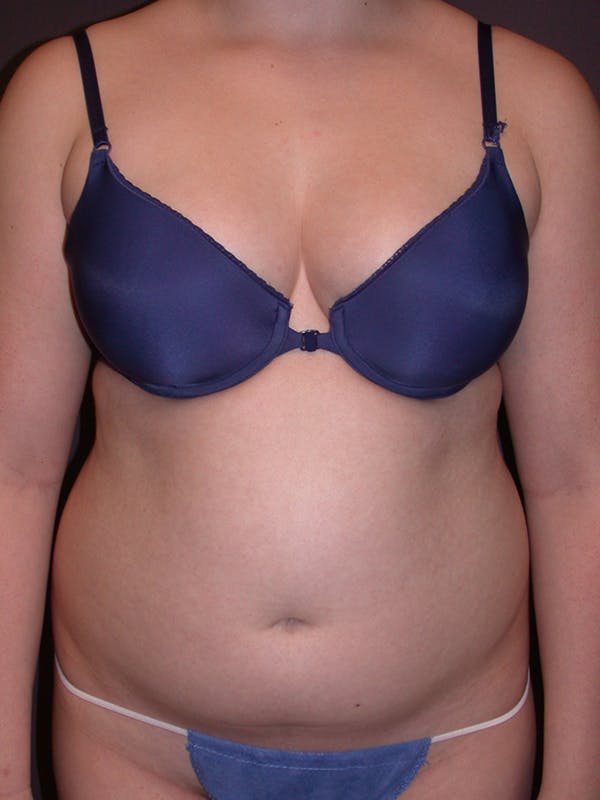 Liposuction Before & After Gallery - Patient 31382055 - Image 1