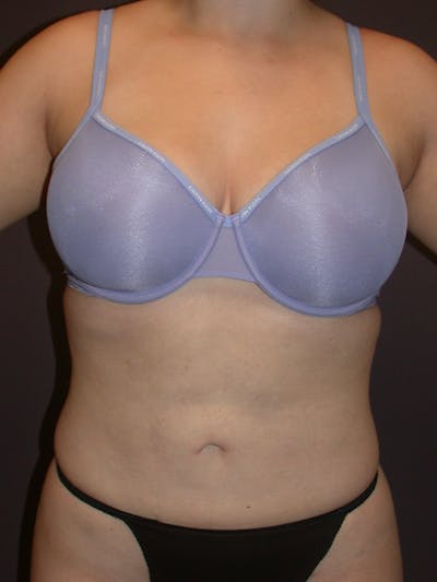 Liposuction Gallery Before & After Gallery - Patient 31382055 - Image 2