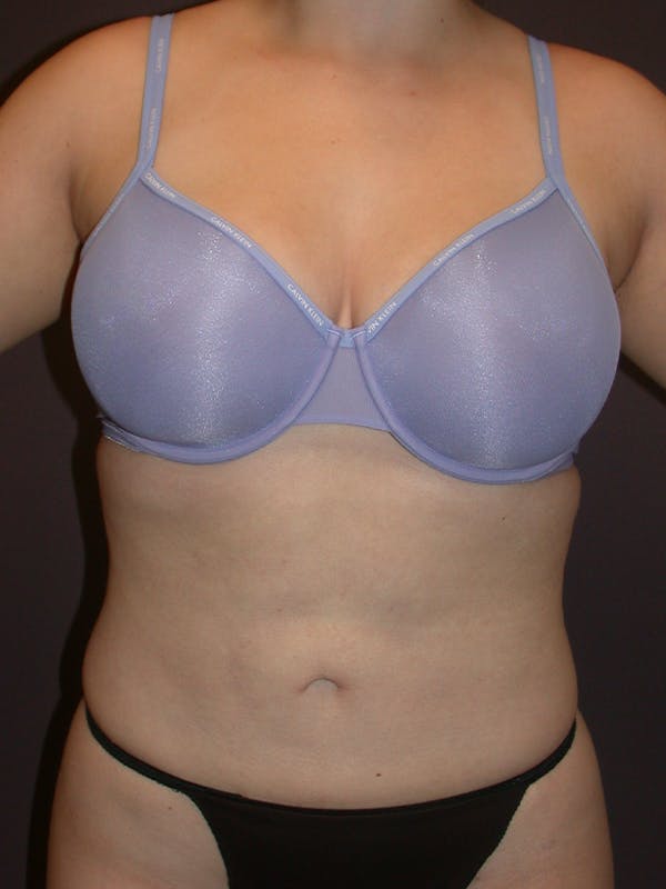 Liposuction Gallery - Patient 31382055 - Image 2