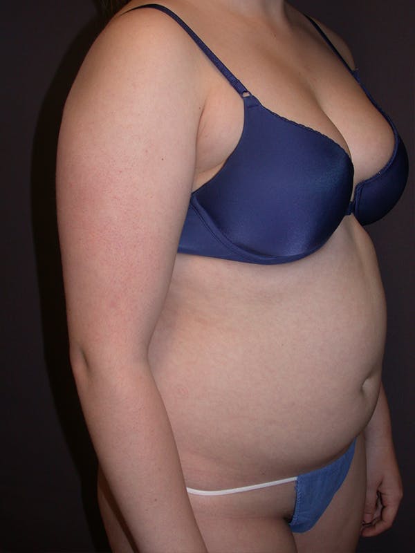 Liposuction Gallery Before & After Gallery - Patient 31382055 - Image 3