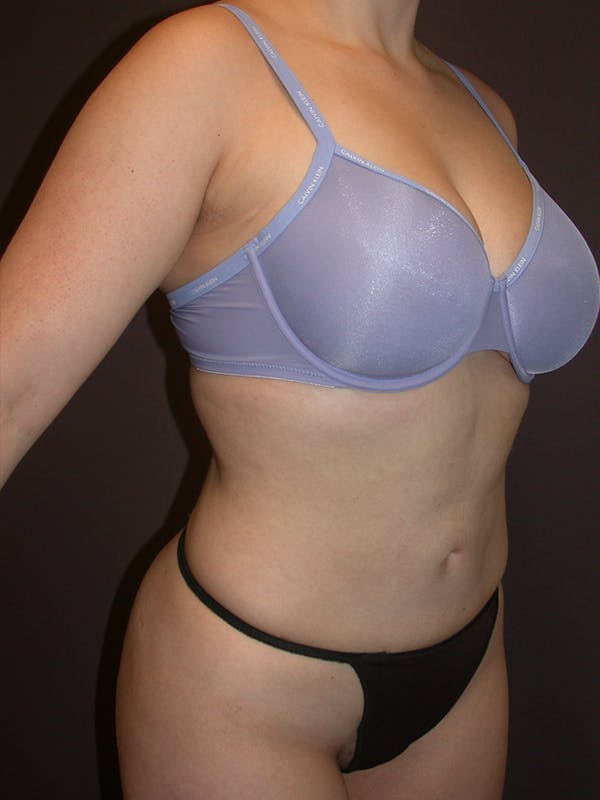 Patient 4 Female Liposuction Before & After