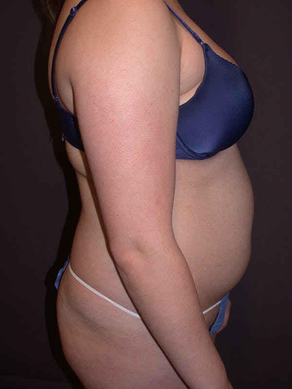 Liposuction Before & After Gallery - Patient 31382055 - Image 5