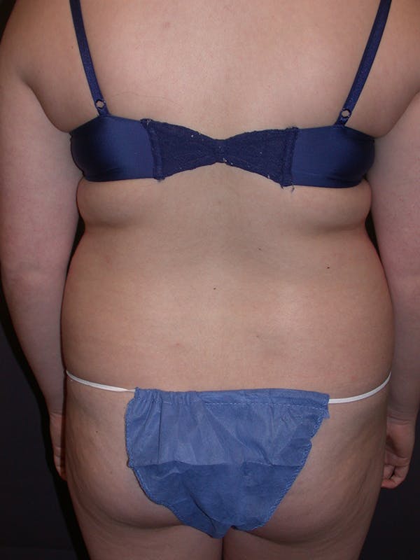 Liposuction Gallery Before & After Gallery - Patient 31382055 - Image 7