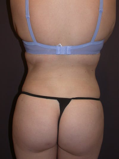 Liposuction Gallery Before & After Gallery - Patient 31382055 - Image 8