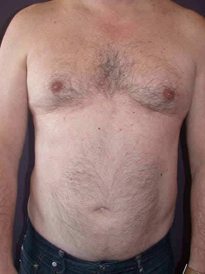 Male Liposuction Before & After Gallery - Patient 31197706 - Image 1