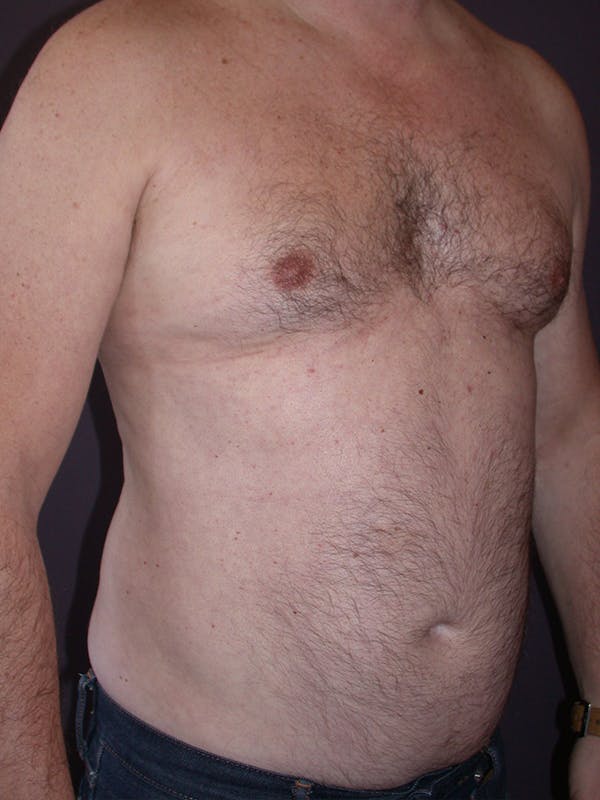 Male Liposuction Gallery Before & After Gallery - Patient 31197706 - Image 3
