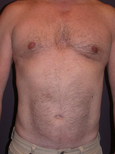 Gynecomastia Gallery Before & After Gallery - Patient 31198002 - Image 2