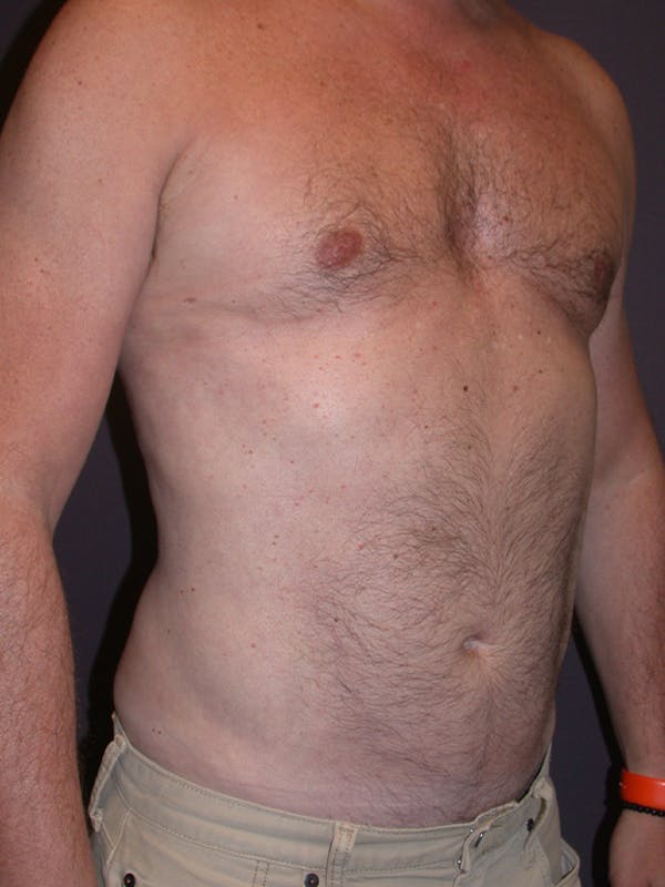 Gynecomastia Gallery Before & After Gallery - Patient 31198002 - Image 4