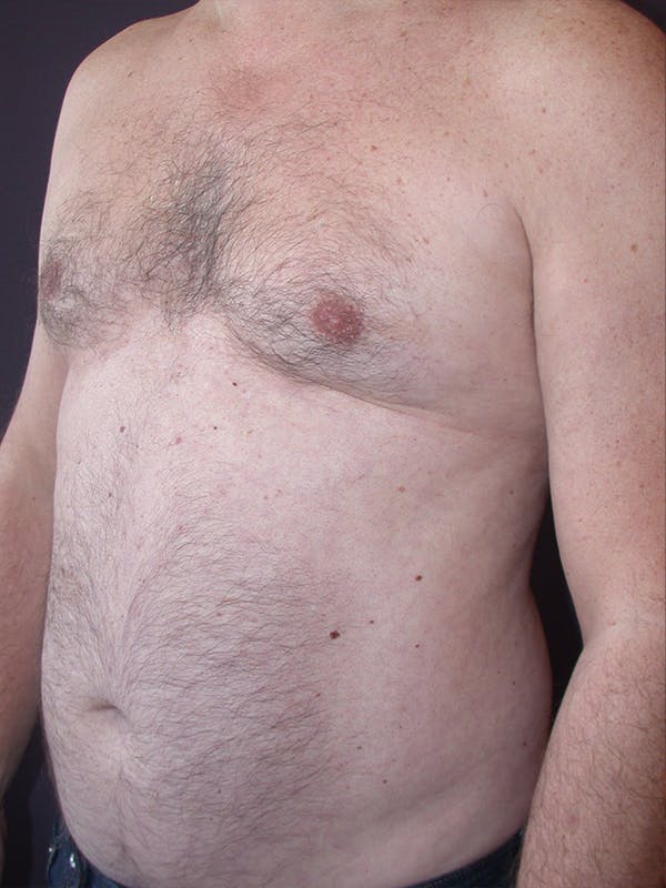 Gynecomastia Gallery Before & After Gallery - Patient 31198002 - Image 5