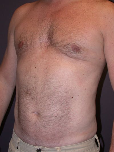 Gynecomastia Gallery Before & After Gallery - Patient 31198002 - Image 6
