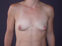 Breast Augmentation Before & After Gallery - Patient 40632786 - Image 1