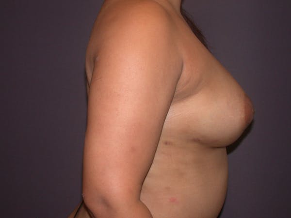 Breast Augmentation with Fat Gallery Before & After Gallery - Patient 40632923 - Image 6