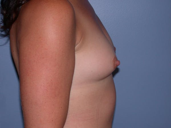 Breast Augmentation Gallery Before & After Gallery - Patient 40633242 - Image 5