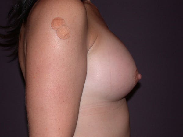 Breast Augmentation Gallery Before & After Gallery - Patient 40633242 - Image 6