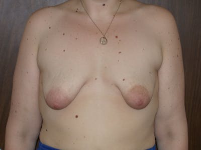 Tubular Breasts Gallery Before & After Gallery - Patient 40633294 - Image 1