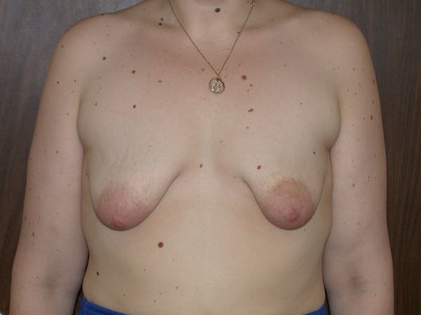Tubular Breasts Before & After Gallery - Patient 40633294 - Image 1