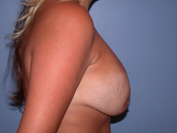 Breast Lift Gallery Before & After Gallery - Patient 40633455 - Image 3