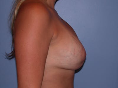 Breast Lift Gallery Before & After Gallery - Patient 40633455 - Image 4